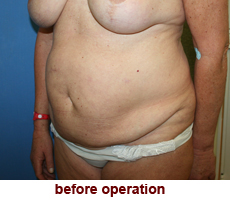 plastic-surgery-tummy-tuck